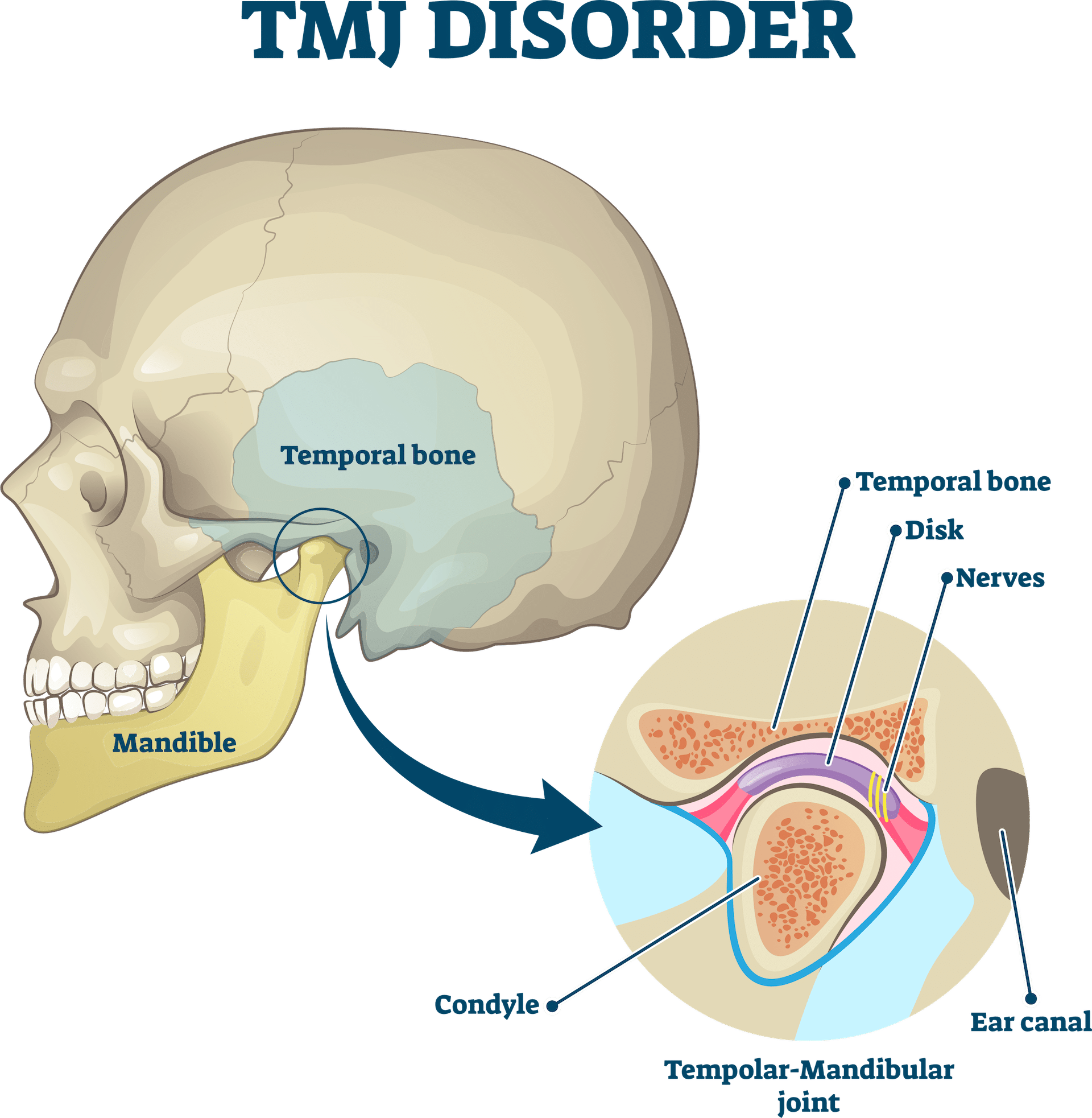 tmj treatment in Saskatoon - Diagram of the TMJ joint